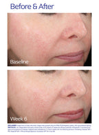 Rozatrol for Red Sensitized Skin
